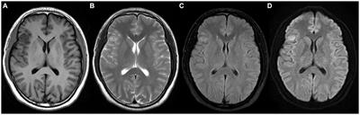 Case report: Meningioma associated with meningioangiomatosis mimicking invasive meningioma